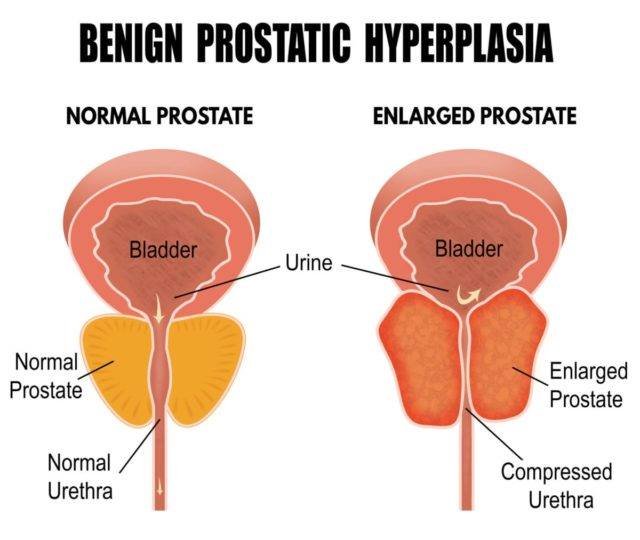 Men's Urinary Health Symptoms